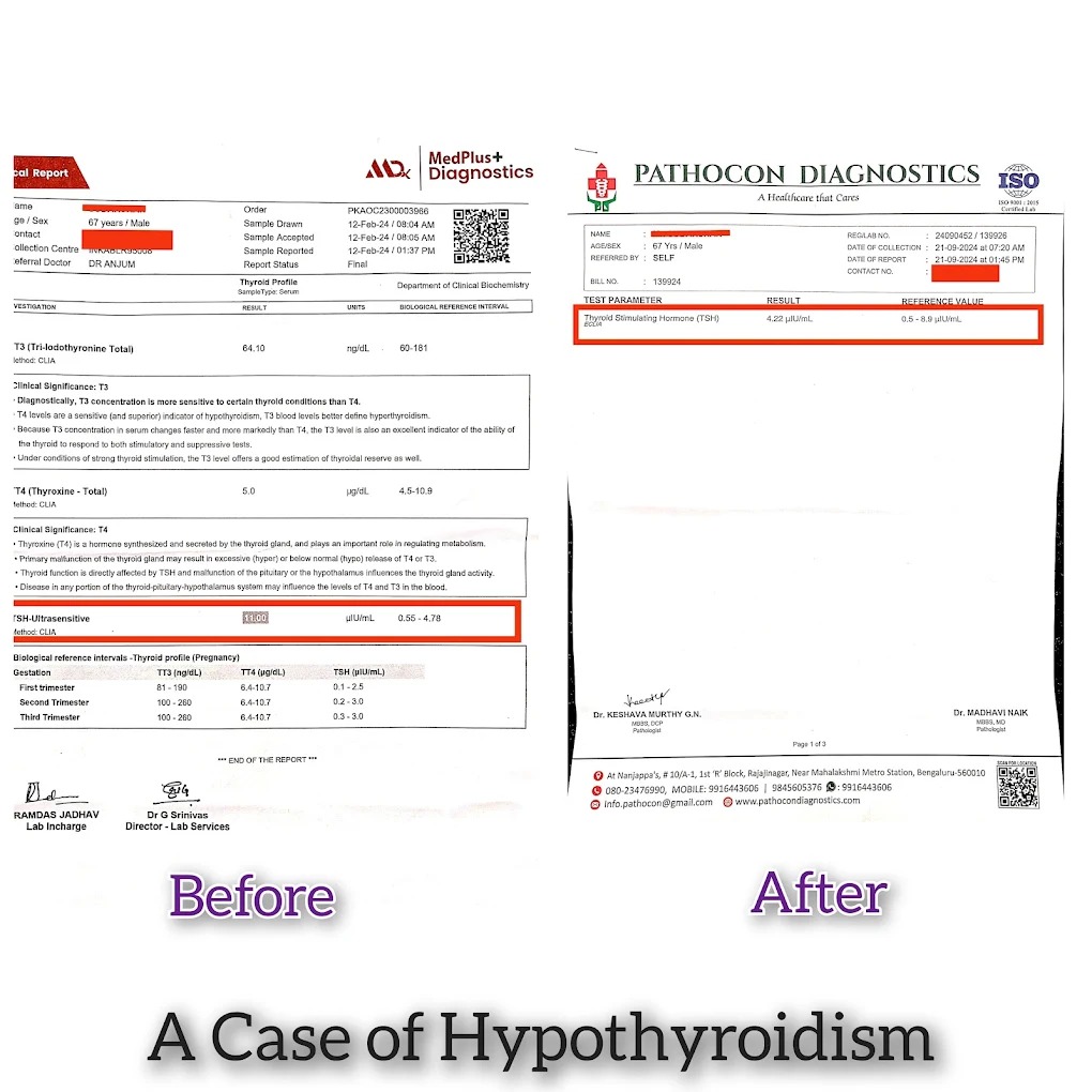 Hypothyroidism Lab Report